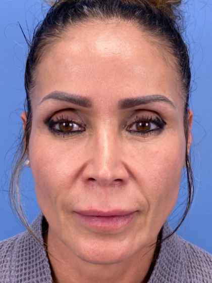 Lip Lift Before & After Patient #13920