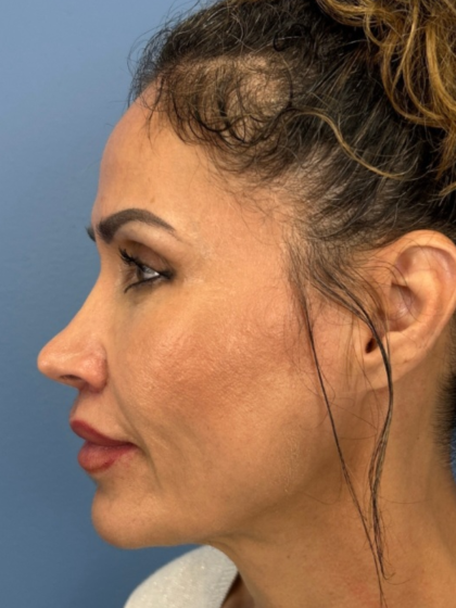 Lip Lift Before & After Patient #13920