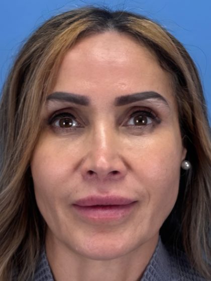 Lip Lift Before & After Patient #13920