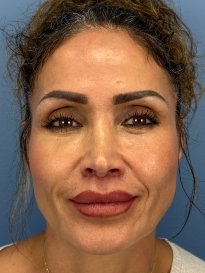 Lip Lift Before & After Patient #13920