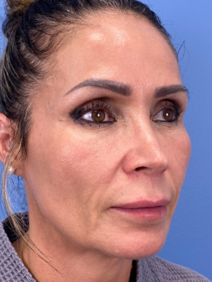 Lip Lift Before & After Patient #13920