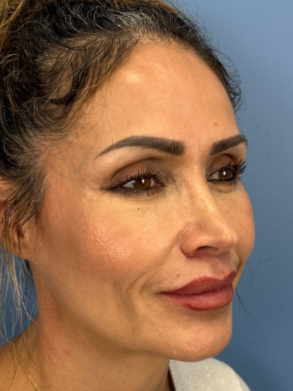 Lip Lift Before & After Patient #13920