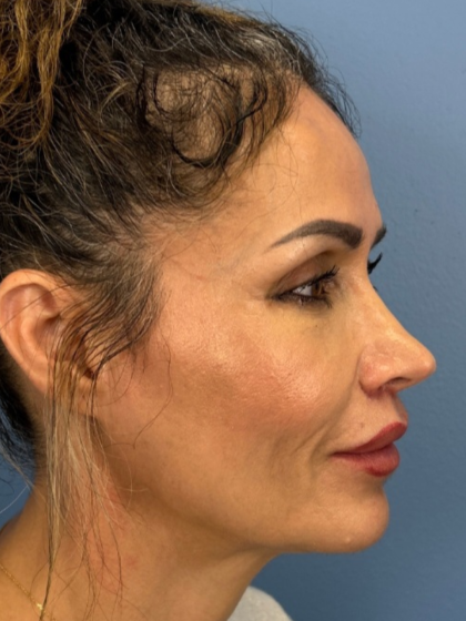 Lip Lift Before & After Patient #13920