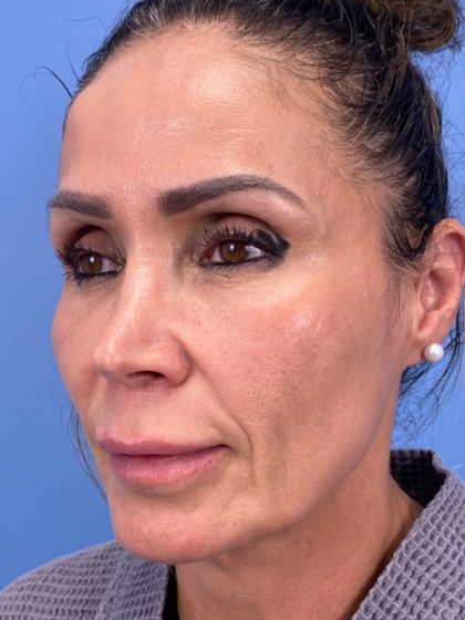 Lip Lift Before & After Patient #13920