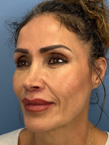 Lip Lift Before & After Patient #13920