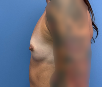 Breast Augmentation Before & After Patient #13931