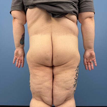 Thigh Lift Before & After Patient #13996