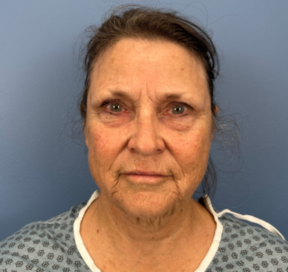 Facelift and Necklift Before & After Patient #14209