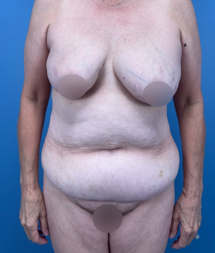 Tummy Tuck Before & After Patient #14258