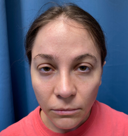 Browlift Before & After Patient #14399