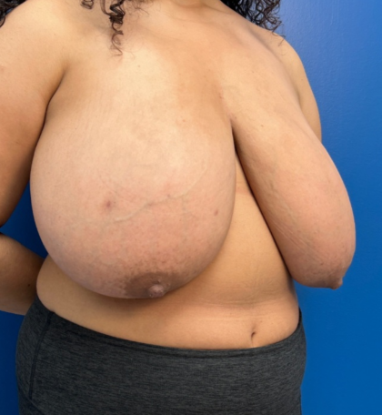 Breast Reduction Before & After Patient #14119