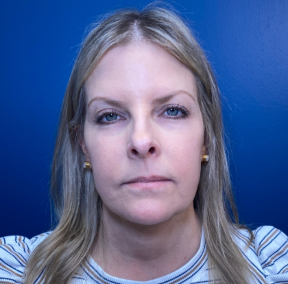 Browlift Before & After Patient #14105