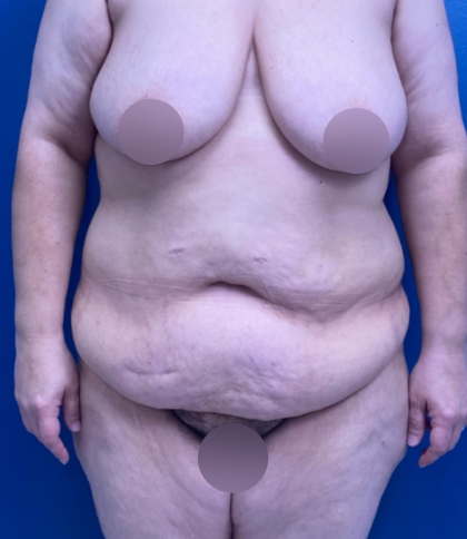 Lower Body Lift Before & After Patient #14186