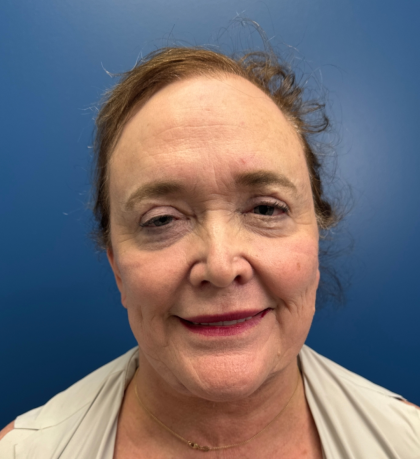 Facial Fat Grafting Before & After Patient #14197