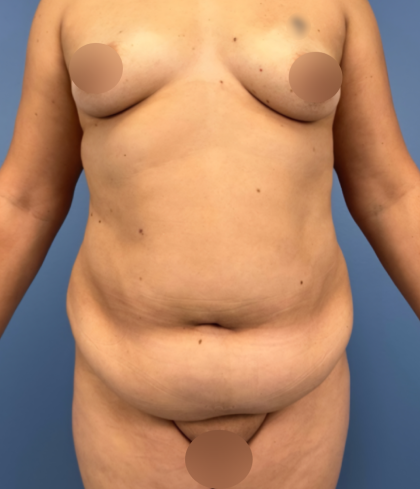 Tummy Tuck Before & After Patient #14208