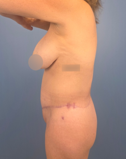 Tummy Tuck Before & After Patient #14116