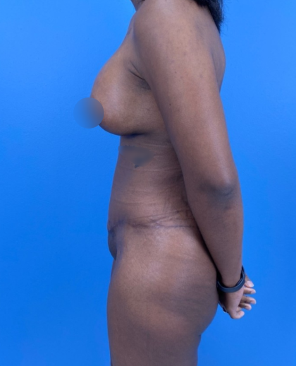 Breast Lift/Mastopexy Before & After Patient #14210