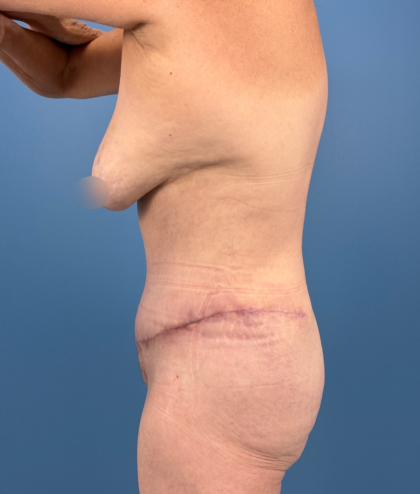 Tummy Tuck Before & After Patient #14258