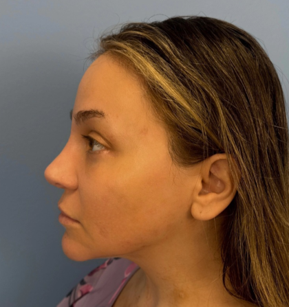 Browlift Before & After Patient #14399