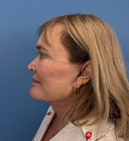 Facelift and Necklift Before & After Patient #14120
