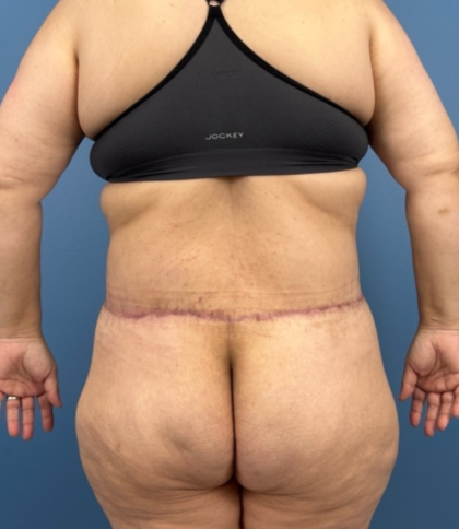 Lower Body Lift Before & After Patient #14186