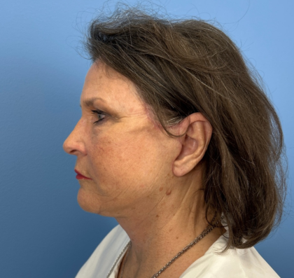 Facelift and Necklift Before & After Patient #14209