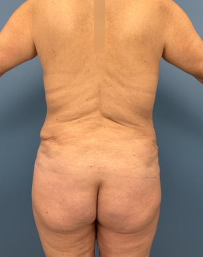 Lower Body Lift Before & After Patient #14173