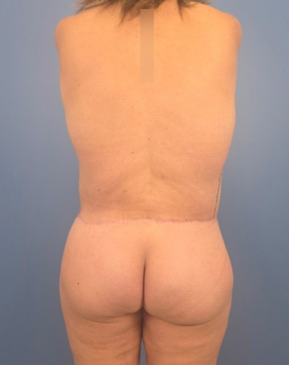 Lower Body Lift Before & After Patient #14173