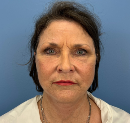 Facelift and Necklift Before & After Patient #14209