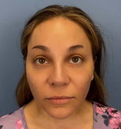 Browlift Before & After Patient #14399