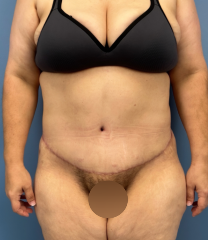 Tummy Tuck Before & After Patient #14117
