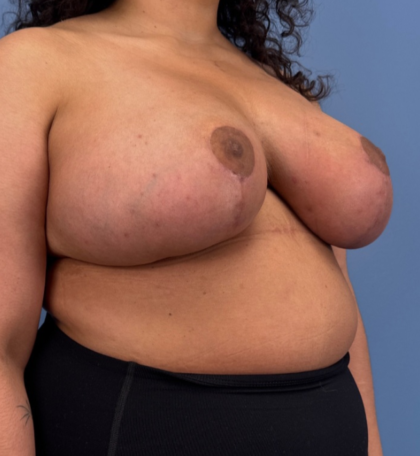 Breast Reduction Before & After Patient #14119