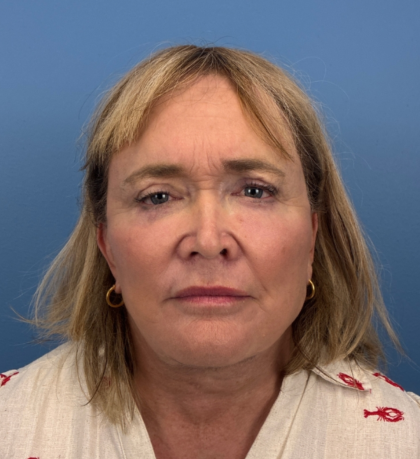 Facelift and Necklift Before & After Patient #14120