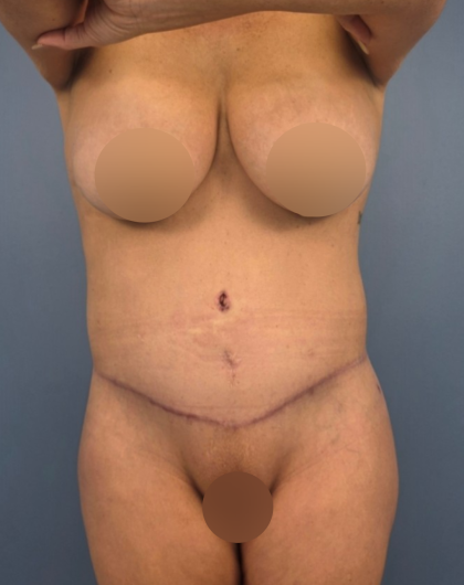Lower Body Lift Before & After Patient #14173