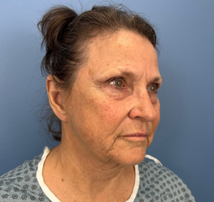 Facial Fat Grafting Before & After Patient #14213