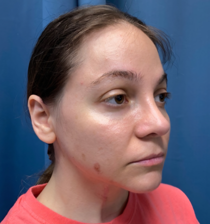Browlift Before & After Patient #14399