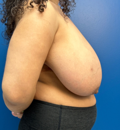 Breast Reduction Before & After Patient #14119