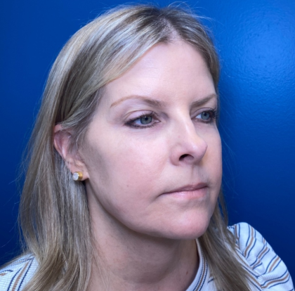 Browlift Before & After Patient #14105