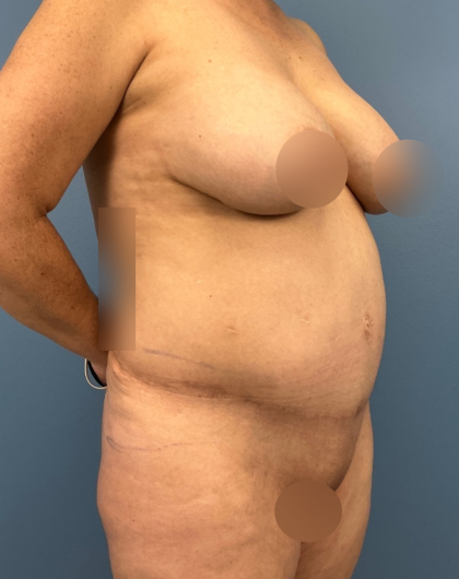 Lower Body Lift Before & After Patient #14173
