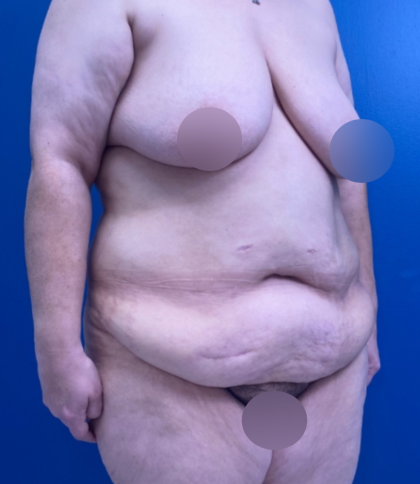 Lower Body Lift Before & After Patient #14186