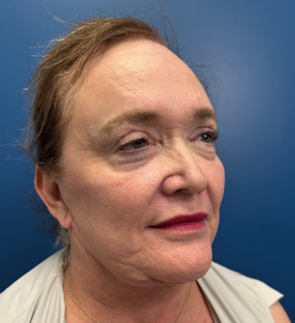 Facial Fat Grafting Before & After Patient #14197