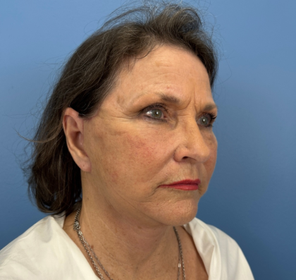 Facelift and Necklift Before & After Patient #14209