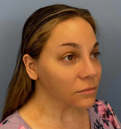 Browlift Before & After Patient #14399
