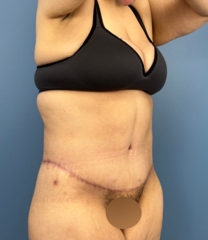 Tummy Tuck Before & After Patient #14117