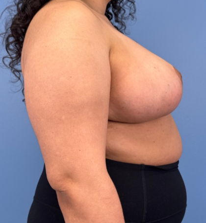 Breast Reduction Before & After Patient #14119