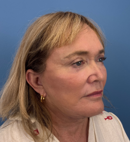 Facelift and Necklift Before & After Patient #14120