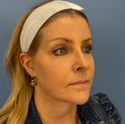 Browlift Before & After Patient #14105