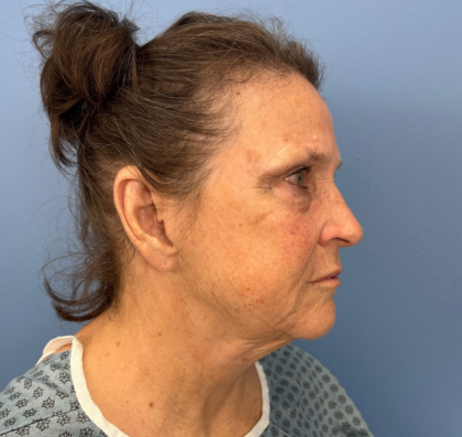 Facial Fat Grafting Before & After Patient #14213