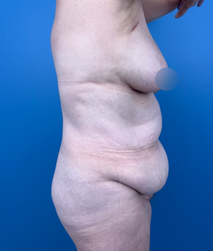Tummy Tuck Before & After Patient #14258