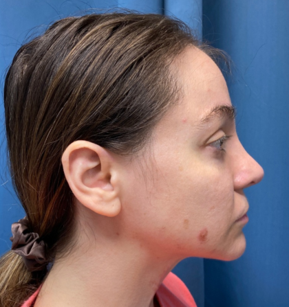 Browlift Before & After Patient #14399